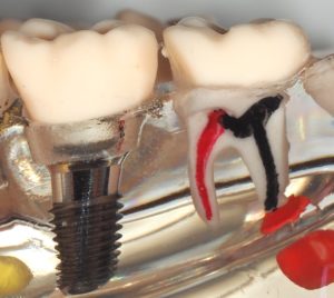 Implant dentaire - Dr Haulot